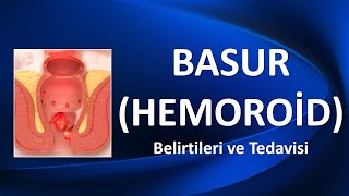 BASUR HEMOROİD NEDİR Belirtileri ve Tedavisi [upl. by Mitinger]