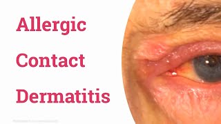 Allergic Contact Dermatitis of Eyelid [upl. by Noiramaj400]