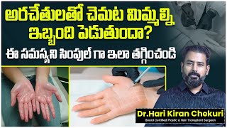 Hyperhidrosis Treatment in Telugu  How to Cure Sweaty Palms Permanently  ReDefine Channel [upl. by Atiuqat]