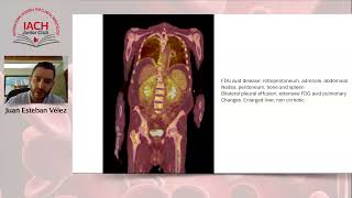 Elder Man with Perinephric Fibrosis [upl. by Zurek]