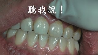 洗牙 牙結石 牙周病聽我說！ [upl. by Halda]