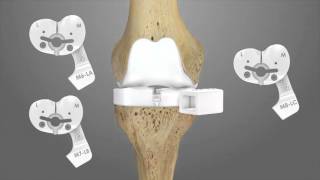 iTotal CR Total Knee Replacement Surgical Technique Animation  Conformis [upl. by Yelwah]