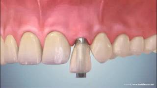 Anew Implants Upper Single Tooth Installation [upl. by Teraj]