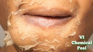 CHEMICAL PEEL Full Process  Procedure  Peeling  Before amp After [upl. by Clemente676]