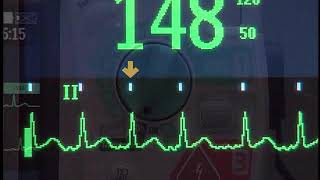 Synchronized Cardioversion with the HeartStart MRx monitordefibrillator [upl. by Atwood]