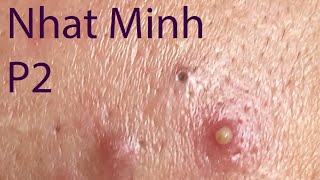 Acne Treatment Huong Da Nang 029  Treatment for Nhat Minh Part 2 [upl. by Anilag]