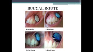 Buccal Route of Drug Administration  Advantages and Disadvantages [upl. by Ramos]