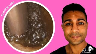 1496  Totally Blocked Ear Wax Removal [upl. by Mathew442]