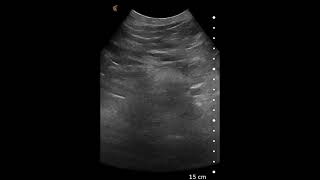 Abdominal Aortic Aneurysm AAA  Ultrasound Image Interpretation [upl. by Teleya]