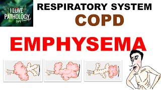 Chronic Obstructive Pulmonary Disease Part 1 Emphysema Pathology [upl. by Rotceh45]