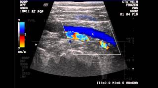 Introduction to the Lower Extremity Venous Doppler Study [upl. by Maise]