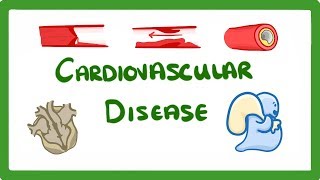 GCSE Biology  Why Do We Get Heart Disease and How to Treat It  Cardiovascular Disease CVD 47 [upl. by Yssirk]