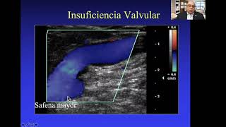 Tips de Doppler Venoso en miembros inferiores  Dr Leandro Fernández [upl. by Ahsikyt]