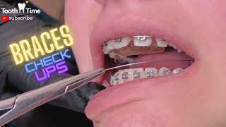 Braces On UPDATE 6 Months of braces journey  Tooth Time Family Dentistry New Braunfels [upl. by Wolram566]