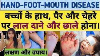 HAND FOOT MOUTH DISEASE  बच्चो के हाथ पैर और चेहरे पर लाल दाने या छाले। Symptoms and Treatment [upl. by Emera898]