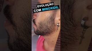 RESULTADO COM MINOXIDIL 2 meses e 26 dias de tratamento barba minoxidil [upl. by Cain]