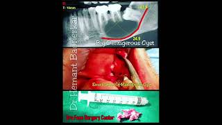 Dentigerous Cyst Case Report [upl. by Bjorn]