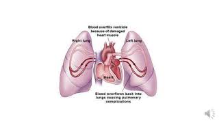 Pharmacotherapy of Congestive Heart Failure 1 Classification aetiology and clinical features [upl. by Cordula]