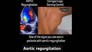 aortic regurgitation signsdancing carotid corrigans sign Sudarshanlipane17 ✨⛑️🏥🏥✨🏆🧪💉💉 [upl. by Anawd]