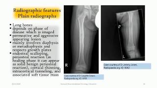 LangerhansCell Histiocytosis of the bone  ‘‘The great mimmicker’’ [upl. by Rumit]