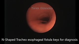 N shaped tracheoesophageal fistula Keys for diagnosis [upl. by Llenahs358]