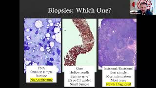 Update on Diffuse Large BCell Lymphoma  Lymphoma Research Foundation Webinars [upl. by Merriott]