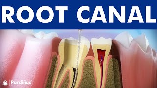 ROOT CANAL treatment step by step  3D video of endodontics for tooth decay © [upl. by Annabelle700]