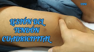 TENDÓN CUADRICIPITAL ROTO  LESIÓN DEL MECANISMO EXTENSOR DE LA RODILLA [upl. by Epoh]