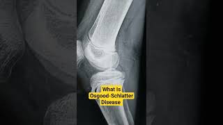 What Is OsgoodSchlatter Disease Dr Sai Chandra osgoodschlatterdisease [upl. by Chilton434]