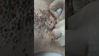 Nevus Comedonicus removal [upl. by Scharf]