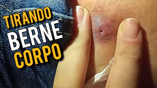 🎯 COMO RETIRAR BERNE NO CORPO HUMANO ❌️ [upl. by Wisnicki238]