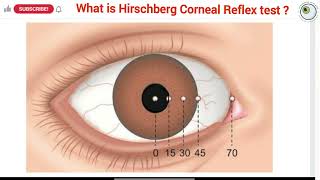 How to perform a hirschberg test  Hirschberg test explained  Interpretation of hirschberg test [upl. by Onofredo838]