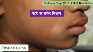 Pityriasis Alba चेहरे पर सफेद दाग Pityriasis PityriasisAlba vitiligo vitiligocure whitespots [upl. by Klepac]