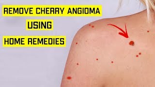 How To Get Rid of Cherry Angioma Naturally  Top 5 Home Remedies for Cherry Angiomas Red Moles [upl. by Pengelly]