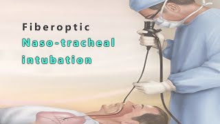 Fiberoptic nasotracheal intubation [upl. by Oiznun]