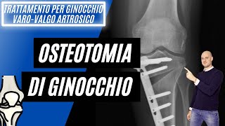 Osteotomia per ginocchio artrosico [upl. by Oecile]