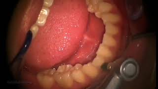 dental exam and ultrasonic scaling no4 up close POV view [upl. by Osithe]