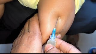 Arms injection video Intramuscular Ceftriaxone 500mg Exephin injection push24 P28 by cannula 69 [upl. by Madonna]