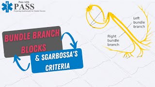 Bundle Branch Blocks amp Sgarbossas Criteria for EMS Pass the NREMT with Pass with PASS [upl. by Nahsar]