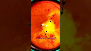 Diabetic retinopathy  Hemorrhages  Hard exudates  Fundus  Short Video 191 [upl. by Grane]