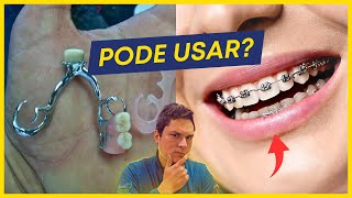 Quem usa prótese pode usar aparelho [upl. by Einhpad]