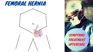 Femoral Hernia Symptoms and Treatment [upl. by Fillander]