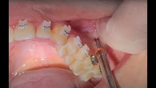 in 2 min IZC mini implant with long shank placing on  screwing in IZC mini screw IZC TAD insertion [upl. by Esimorp]