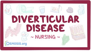 Diverticular disease Clinical Nursing Care [upl. by Bacchus]