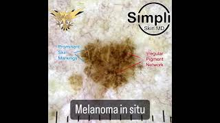 Melanoma in situ [upl. by Aloivaf]