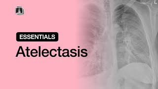 Atelectasis  Chest Radiology Essentials [upl. by Ailam102]