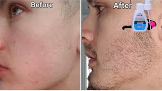 minoxidil beard growth  3 month transformation  mintop minoxidil review  derma roller for beard [upl. by Genevra]