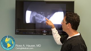 Cause of occipital neuralgia and migraines seen on DMX and resolved with Prolotherapy [upl. by Marcile]