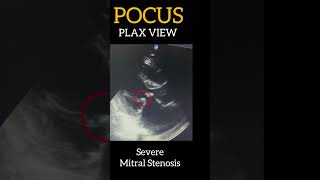 POCUS  Severe Mitral Stenosis  2D ECHO  PLAX View [upl. by Oigufer480]