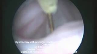 Cystoscopy with posterior urethral valve fulguration by Dr Shandip SinhaPediatric Urologist [upl. by Irianat]